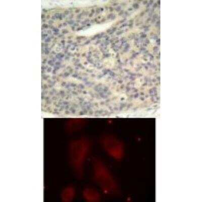 Immunohistochemistry-Paraffin: LIM Kinase 1/2 [p Thr505, p Thr508] Antibody [NBP2-54645] - Top Image: Immunohistochemical analysis of paraffin-embedded human breast carcinoma tissue using LIMK1 (Phospho-Thr508).Bottom Image: Immunofluorescence staining of methanol-fixed HeLa cells using LIMK1 (Phospho-Thr508).